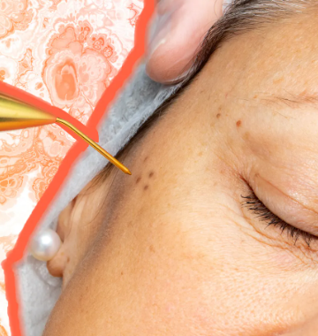 Effective Plasma Pen Treatment for Skin [That Really Work]